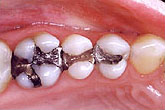 fillings_3