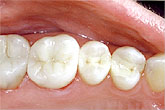 fillings_5